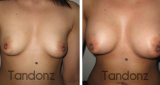 breast_augmentation7-big