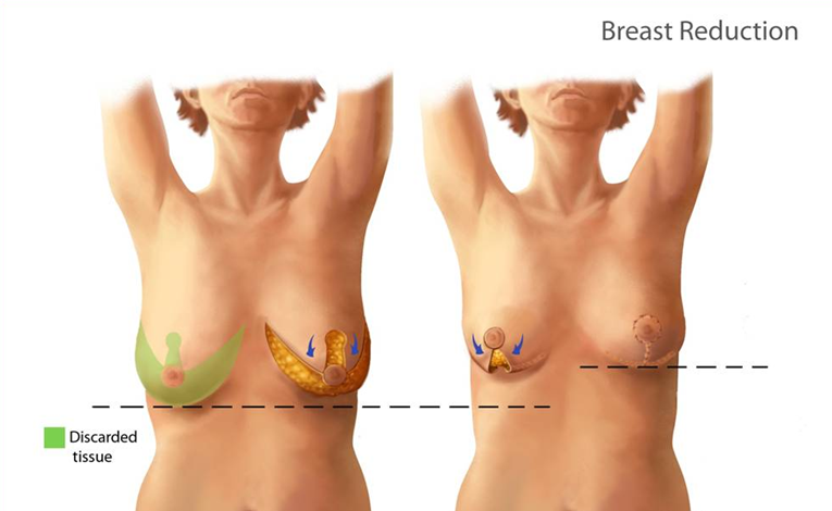 breast_reduction