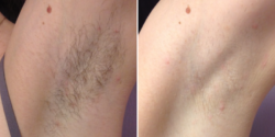 Axillary Hair removal by Diode