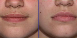 Facial Hair Reduction by Diode Laser