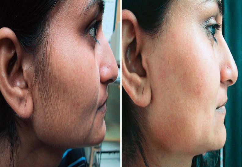 Facial  Hair Removal by Diode Laser